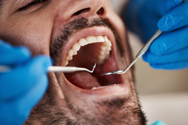 Best Knocked-Out Tooth (Avulsed Tooth) Treatment in Lincoln, AL